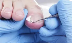 Tırnak mantarını önlemek için yapılması gerekenler