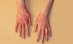 Lateks Alerjisi Nedir? Belirtileri ve Korunma Yolları