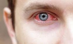 Adenovirüs Nedir? Kaç Günde Geçer? Belirtileri, Bulaşma Yolları ve Tedavisi