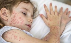 Rubella (Kızamıkçık) Nedir? Belirtileri ve Korunma Yolları