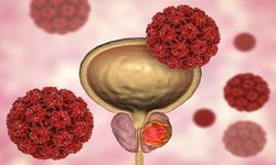 Kötü Huylu Prostat Kanseri Tedavisi: Etkili Yaklaşımlar ve Cerrahi Seçenekler