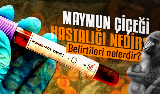 Maymun Çiçeği virüsü nedir, belirtileri nelerdir?