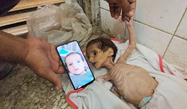 Gazze'de her gün 100'den fazla çocuk yetersiz beslenmeyle hastaneye yatırılıyor