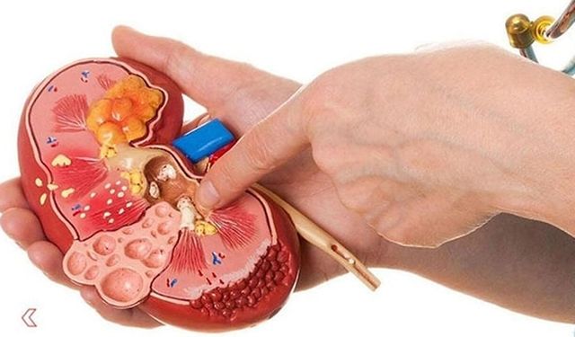 Kum Dökme Nedir? Kum Dökme Neden Olur?