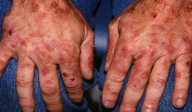 Porfiria Nedir? Vampir Hastalığı