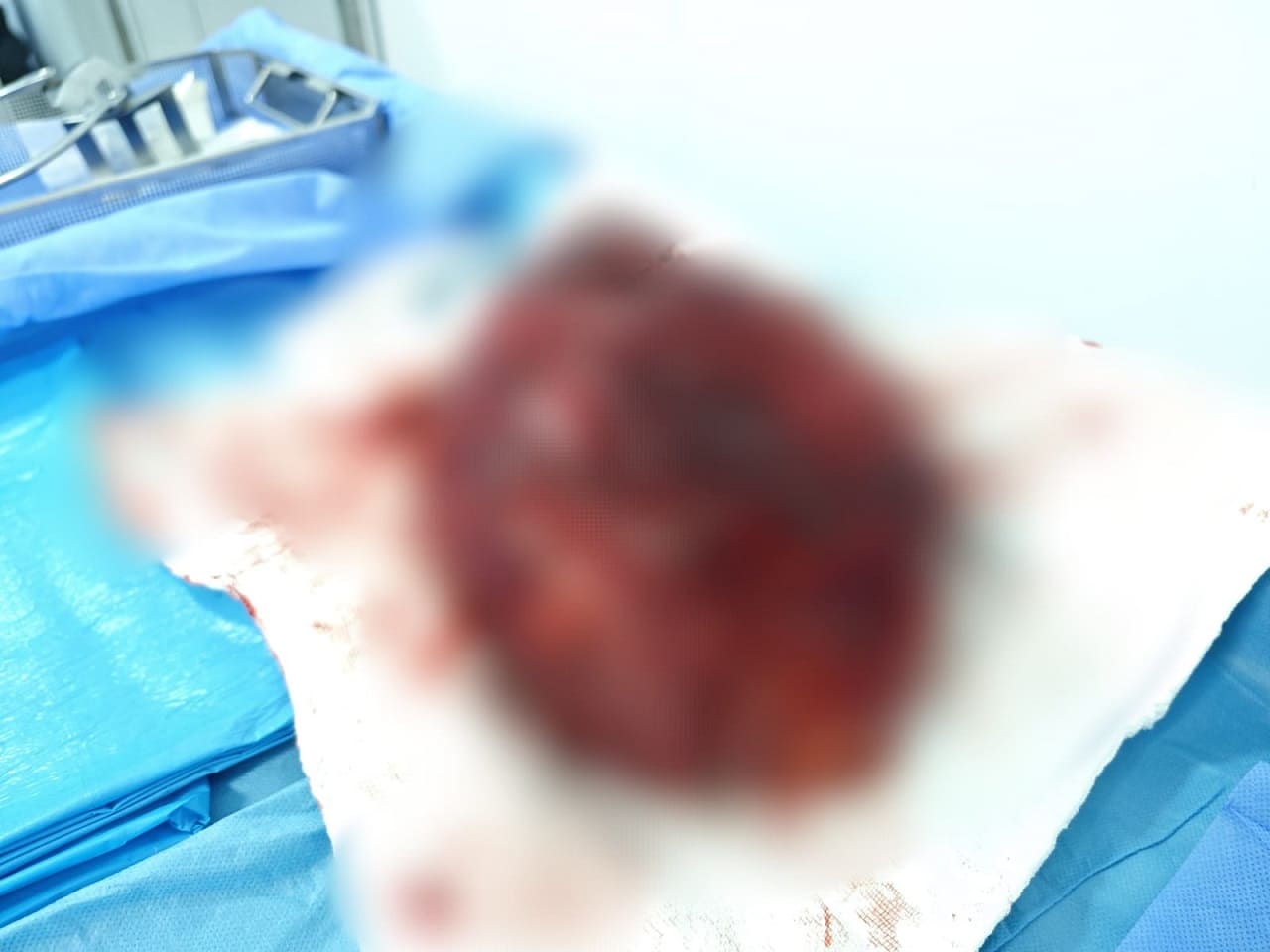 Vanlı Çiftçinin Karnından 4 Kiloluk Dev Kitle Çıktı (5)